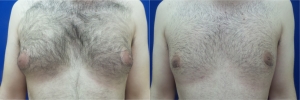 gynecomastia-before-after-photo-15-1