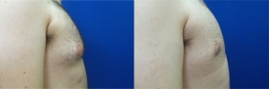 gynecomastia-before-after-photo-15-2