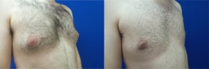 gynecomastia-before-after-photo-15-3