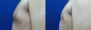 gynecomastia-before-after-photo-15-4