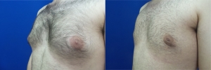 gynecomastia-before-after-photo-15-5
