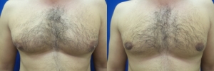 gynecomastia-before-after-photo-16-1