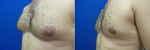 gynecomastia-before-after-photo-16-2