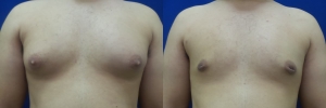 gynecomastia-before-after-photo-17-1
