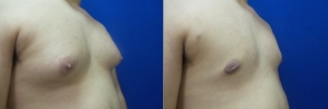 gynecomastia-before-after-photo-17-2