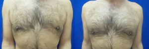 gynecomastia-before-after-photo-18-1