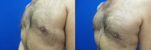 gynecomastia-before-after-photo-18-2