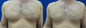 gynecomastia-before-after-photo-19-1