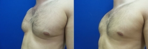 gynecomastia-before-after-photo-19-2