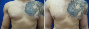 gynecomastia-before-after-photo-3-1