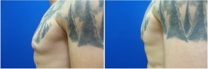 gynecomastia-before-after-photo-3-2