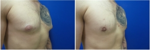 gynecomastia-before-after-photo-3-3
