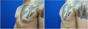 gynecomastia-before-after-photo-3-4