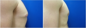 gynecomastia-before-after-photo-3-5