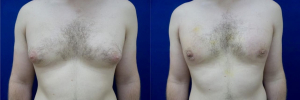 gynecomastia-plastic-surgery-nyc-before-after-10