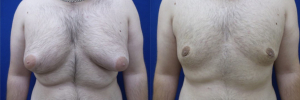 gynecomastia-plastic-surgery-nyc-before-after-11