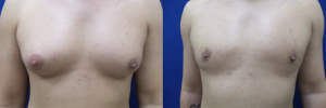 gynecomastia-plastic-surgery-nyc-before-after-12