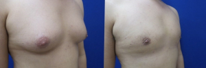 gynecomastia-plastic-surgery-nyc-before-after-13