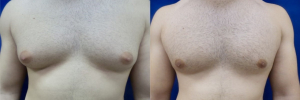 gynecomastia-plastic-surgery-nyc-before-after-14