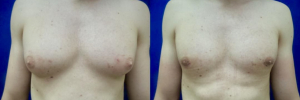 gynecomastia-plastic-surgery-nyc-before-after-15