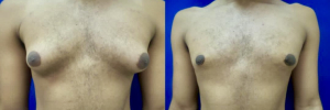 gynecomastia-plastic-surgery-nyc-before-after-16