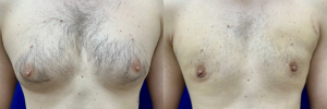 gynecomastia-plastic-surgery-nyc-before-after-17