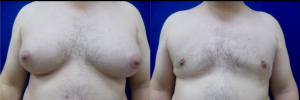 gynecomastia-plastic-surgery-nyc-before-after-18
