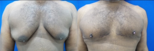 gynecomastia-plastic-surgery-nyc-before-after-19