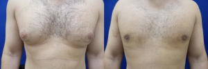 gynecomastia-plastic-surgery-nyc-before-after-4