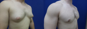 gynecomastia-plastic-surgery-nyc-before-after-5