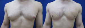 gynecomastia-plastic-surgery-nyc-before-after-6