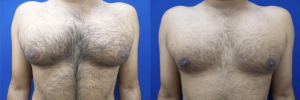 gynecomastia-plastic-surgery-nyc-before-after-7