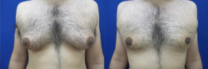 gynecomastia-plastic-surgery-nyc-before-after-8