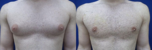 gynecomastia-plastic-surgery-nyc-before-after-9