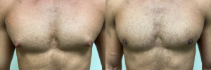 gynecomastia-surgery-nyc-before-after-photo-19
