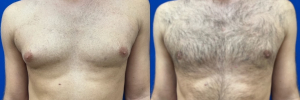 gynecomastia-surgery-nyc-before-after-photo-20