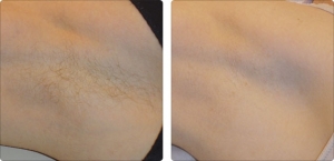 soprano_armpit_1