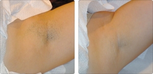 soprano_armpit_2