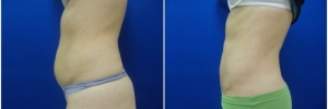 liposuction-10-1