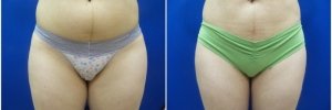 liposuction-10-2