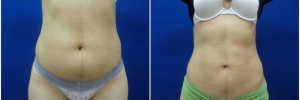 liposuction-10-3