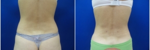 liposuction-10-4