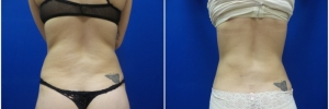 liposuction-5-1
