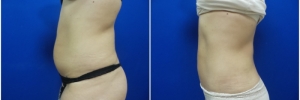 liposuction-5-2