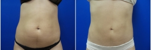 liposuction-5-3
