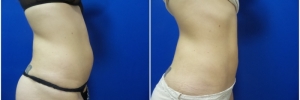 liposuction-5-4