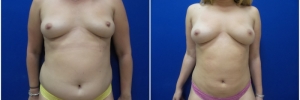 liposuction-6-1