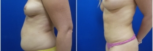 liposuction-6-2