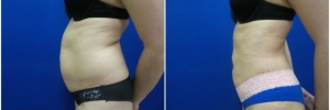 liposuction-7-1