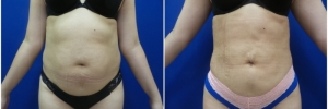 liposuction-7-2